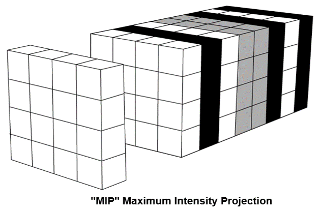 Maximum Intensity Projection