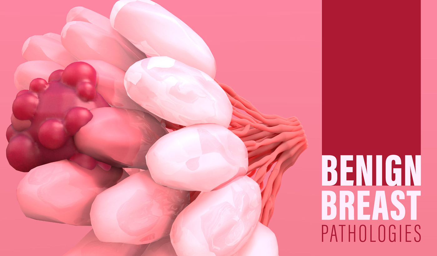 Benign Breast Pathologies