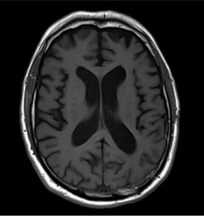 Coupe axiale pondérée T1 d’un crâne