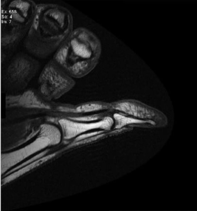 Example Sagittal T1 Thumb