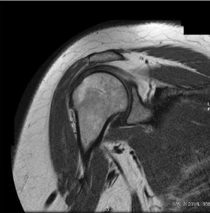 Example Coronal T1 shoulder