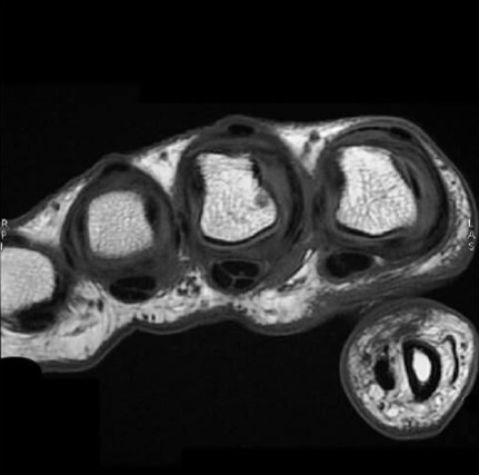 Example Coronal T1 Hand