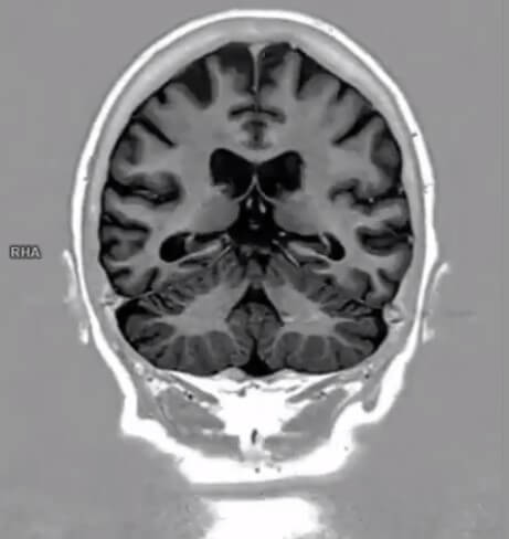 T1 weighted IR of a brain