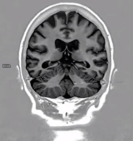 Coupe Coronale IR  pondérée en T1 du Cerveau