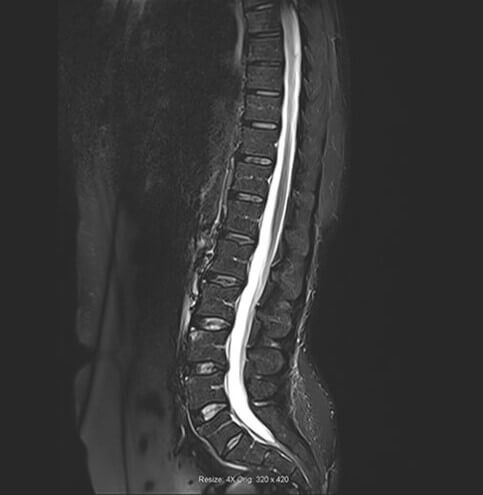 Sagittal IR of the lumbar spine