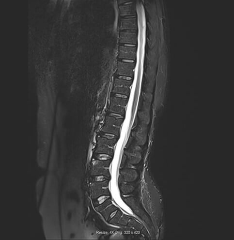 Coupe Sagittale IR de la colonne lombaire