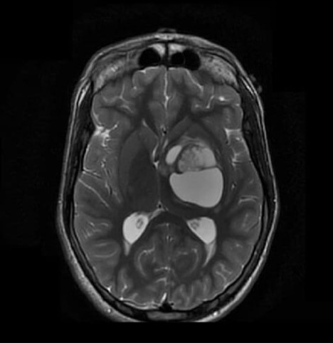 Axial T2 weighted TSE of the brain