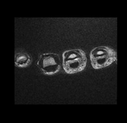 Axial T2 weighted FSE of the hand