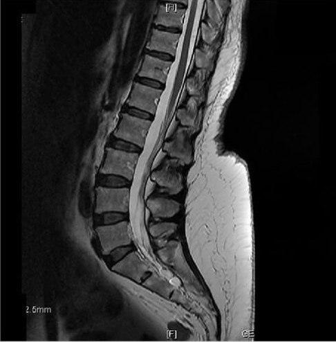 Sagittal T2 weighted FSE of the lumbar spine