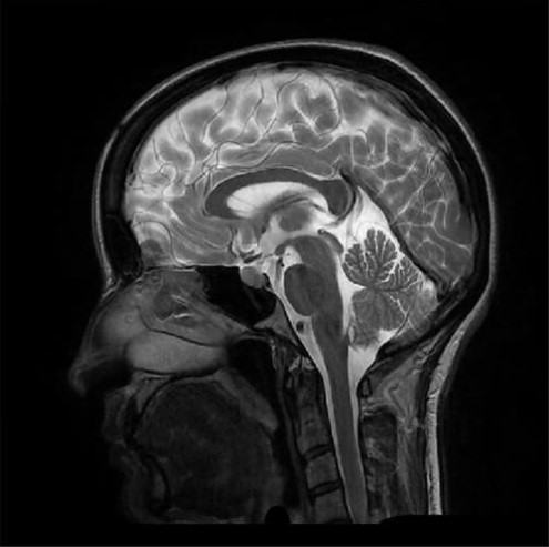 Coupe sagittale TSE pondérée en T2 d’un cerveau