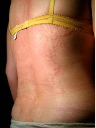 Urticaria