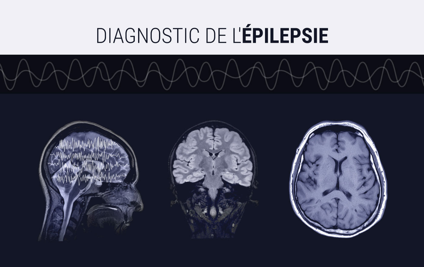 Protocoles IRM pour le diagnostic de l'épilepsie