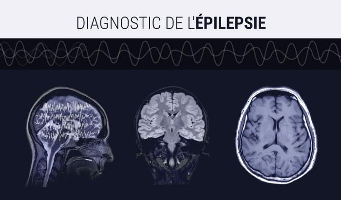 Protocoles IRM pour le diagnostic de l'épilepsie