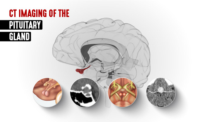 CT Imaging of the Pituitary Gland