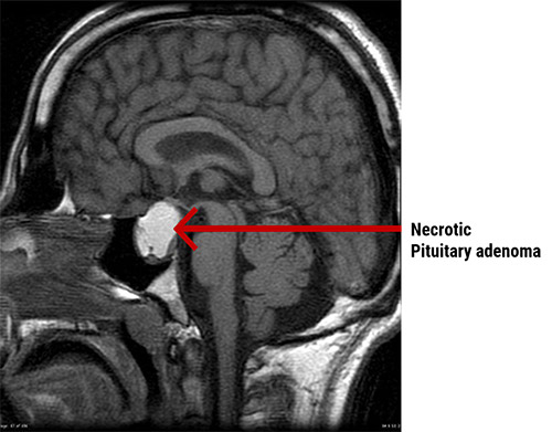 Necrotic Pituitary Adenoma