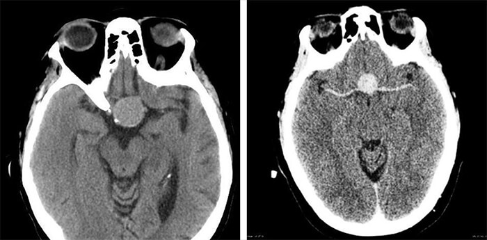 CT images of tumors in the pituitary gland