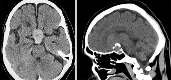 CT in evaluating pituitary gland lesions