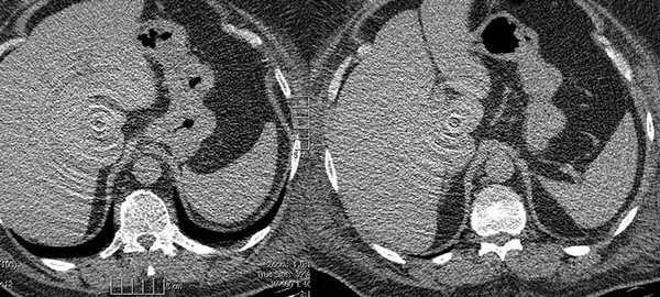 Artifacts - ct scan renal protocol