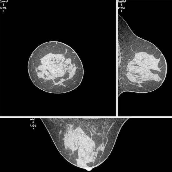 Dedicated Research 2 in breast CT scan