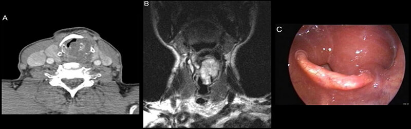 Laryngeal Pathology 2