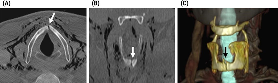 Laryngeal Trauma