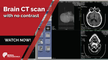 Brain CT Scan with No Contrast