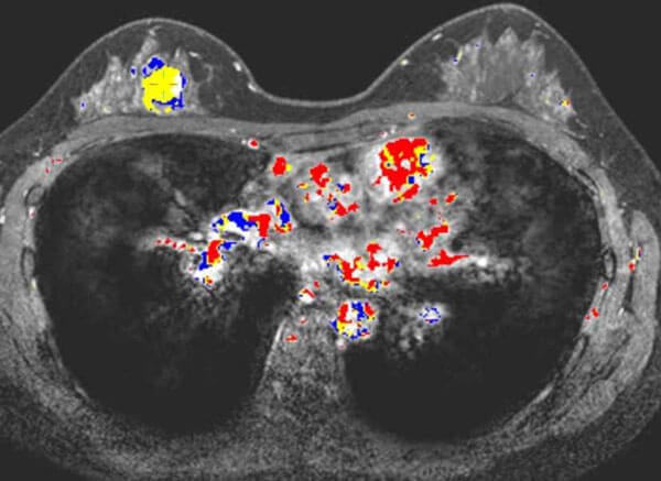 Helping to Detect Breast Cancer with Artificial Intelligence
