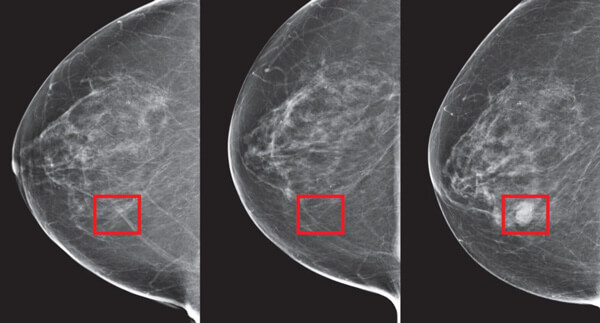 Helping to Detect Breast Cancer with Artificial Intelligence