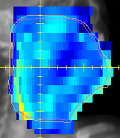 intensity-modulated radiation therapy Planning and Case Results