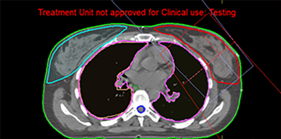 Prostate Cancer IMRT Plan Results