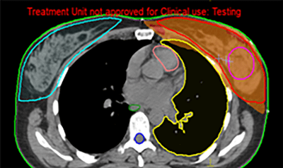 Prostate Cancer IMRT Plan Results