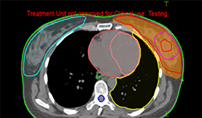 Prostate Cancer IMRT Plan Results