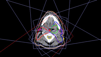 Head and Neck Cancer - intensity-modulated radiation therapy