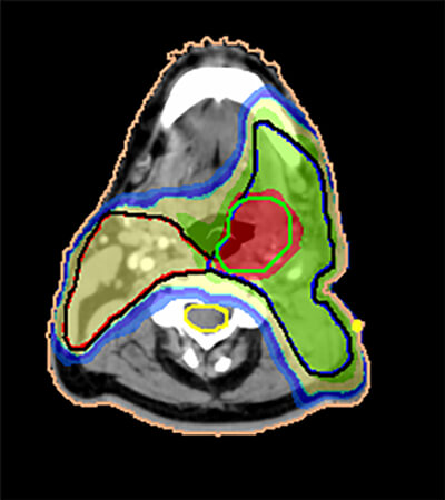 Head and Neck Cancer Results - - intensity-modulated radiation therapy