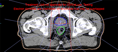 Prostate Cancer intensity-modulated radiation therapy Planning