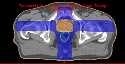 Prostate Cancer IMRT Plan Results