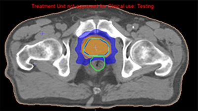 Prostate Cancer IMRT Plan Results