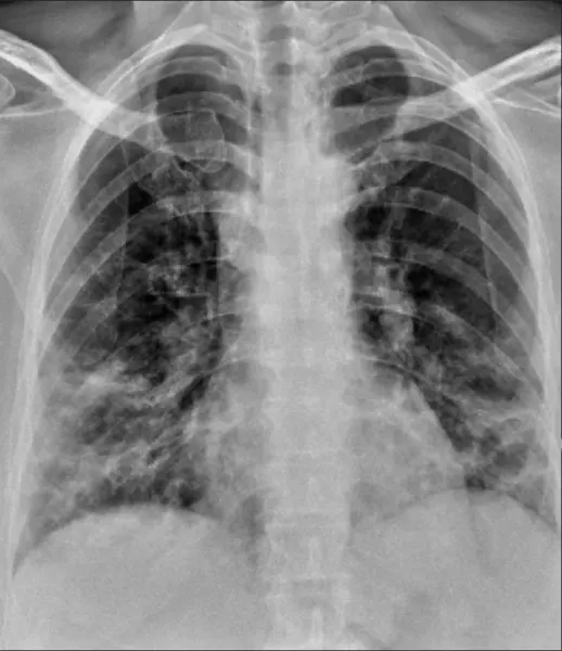 The Role of Chest Radiography in the Diagnosis of COVID-19