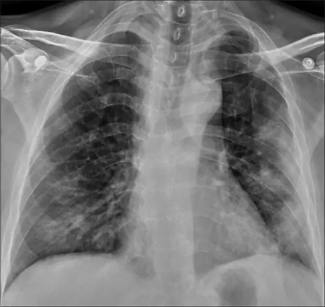 The Role of Chest Radiography in the Diagnosis of COVID-19
