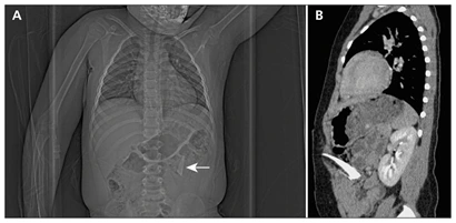 Skeletal Trauma and Child Abuse in Pediatric Imaging