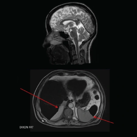 MRI Sequences and Saturation Techniques