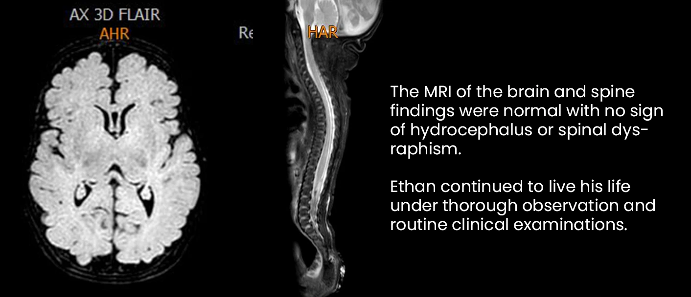 Unveiling Verheij Syndrome: MRI Findings Illuminate a Unique Clinical Feature