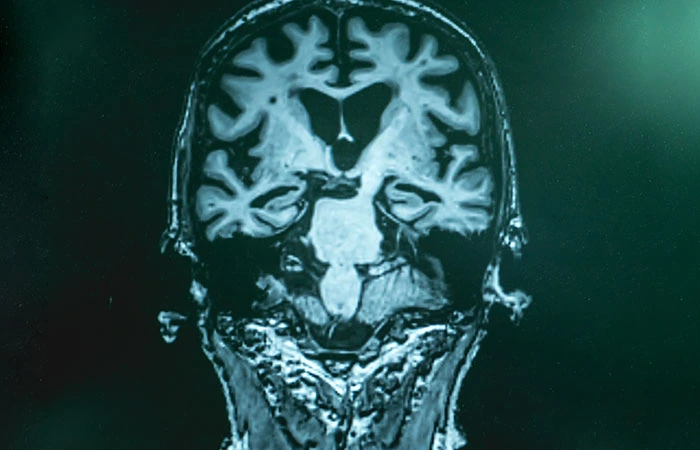 PET scan for Alzheimer's