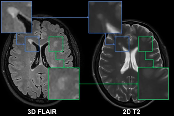3D FLAIR vs. 2D Dual echo T2/DP in Multiple Sclerosis