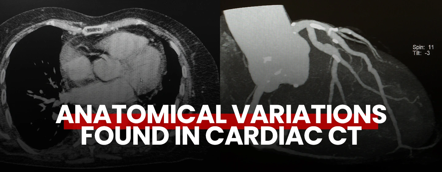 Anatomical Variations Found in Cardiac CT