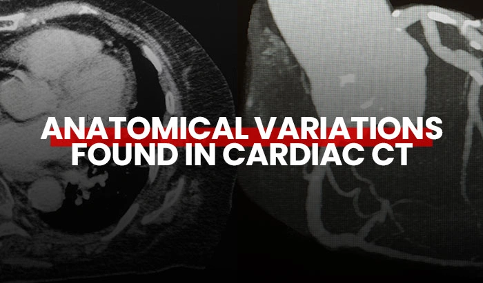 Anatomical Variations Found in Cardiac CT