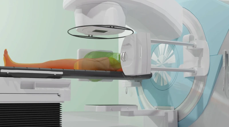 Innovations in Radiation Therapy: Current Advances and Impacts