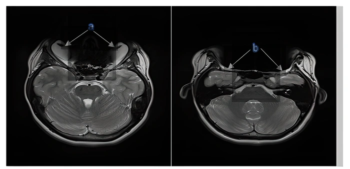 Artefact métallique en IRM: la formation