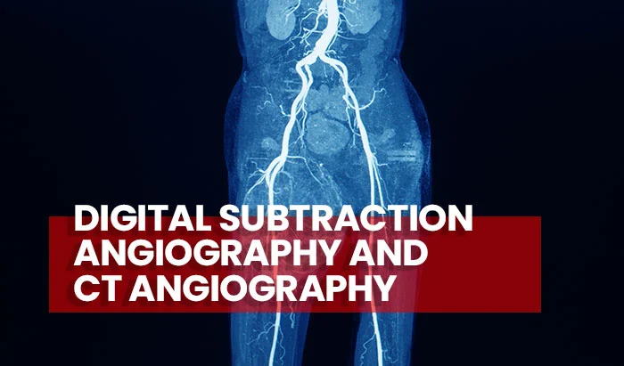 Digital Subtraction Angiography and CT Angiography