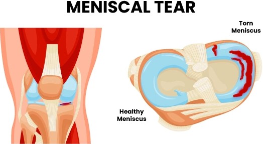 Meniscal tear